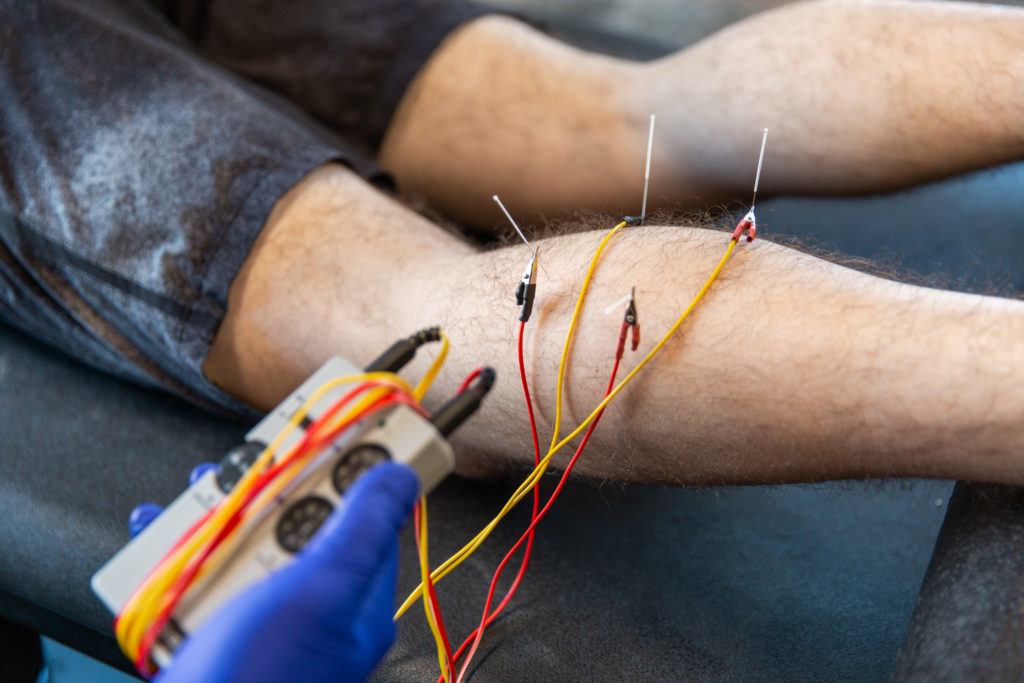 we use dry needling in kansas city to alleviate a variety of pain points