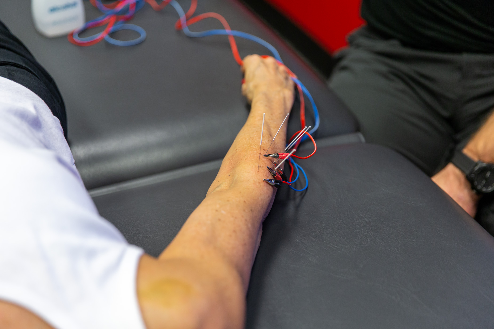 Dry Needling Electrical Stimulation (E-Stim) Treatment: Manage Neck &  Shoulder Pain 