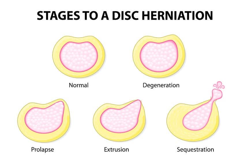 disc herniation diagram