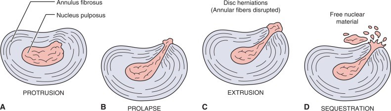 treatment for herniated disc in kansas city - diagram of herniated discs